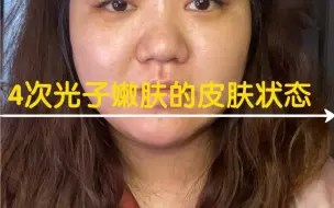 Download Video: 4次光子嫩肤间隔4个月的皮肤状态