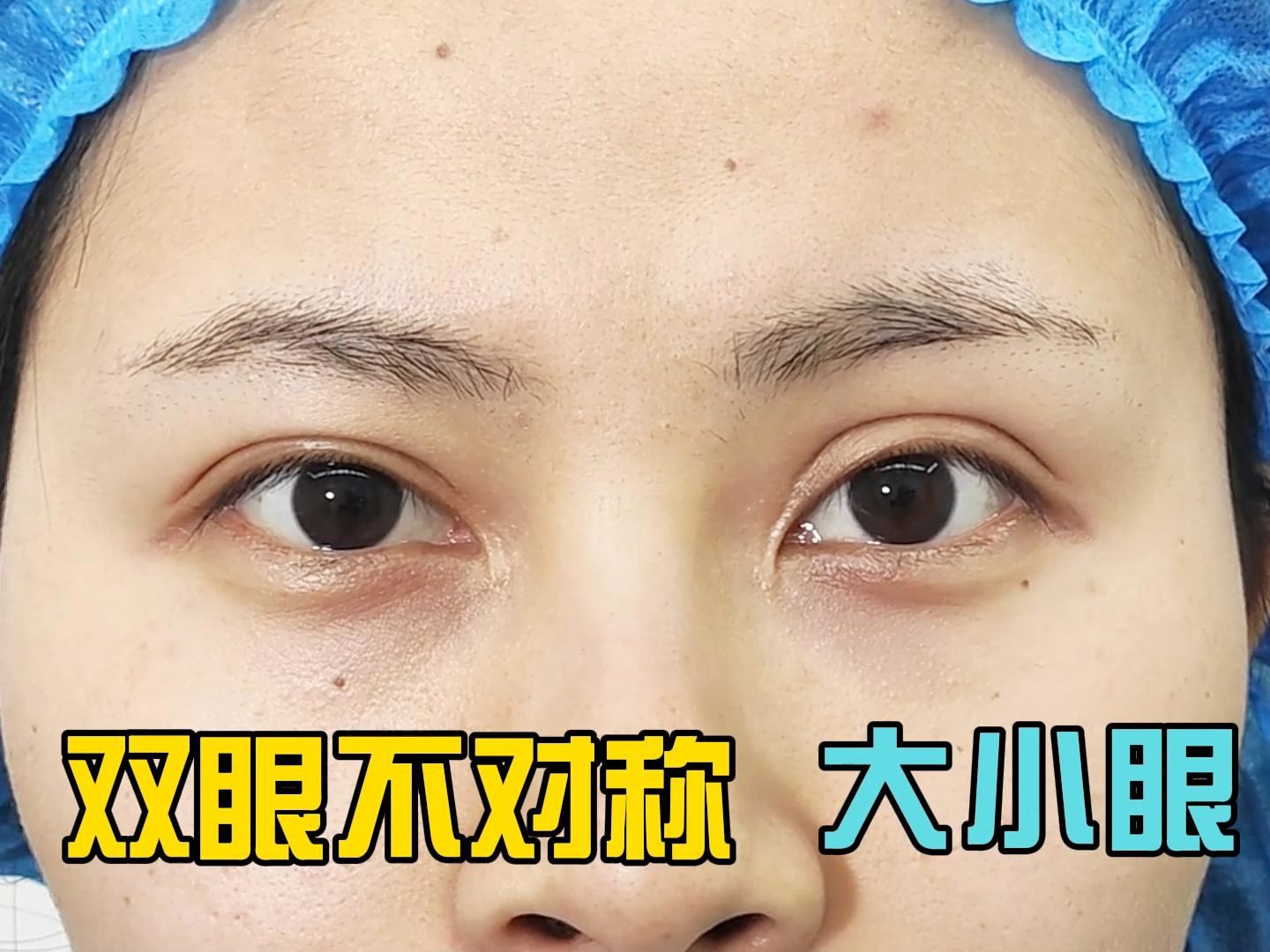 双眼皮不对称 大小眼 双眼皮人工痕迹明显 线条不流畅