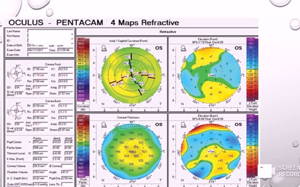 How to read corneal tomography printout:Pentacam  角膜地形图判读3哔哩哔哩bilibili