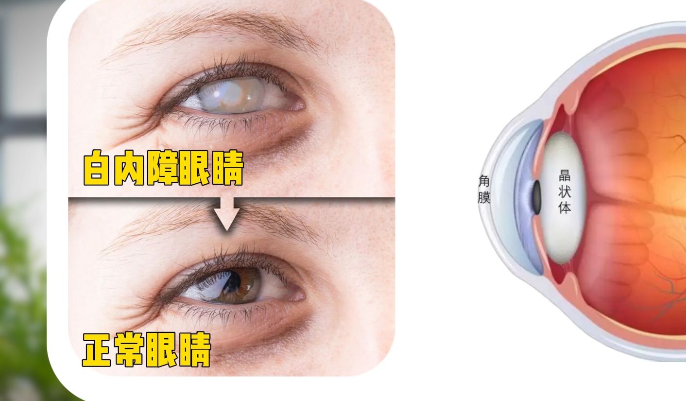 白内障为什么会导致视力下降?