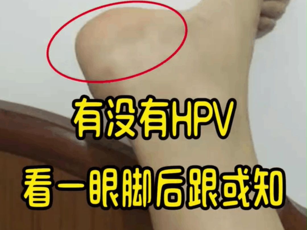 脚底人乳头瘤病毒图片图片