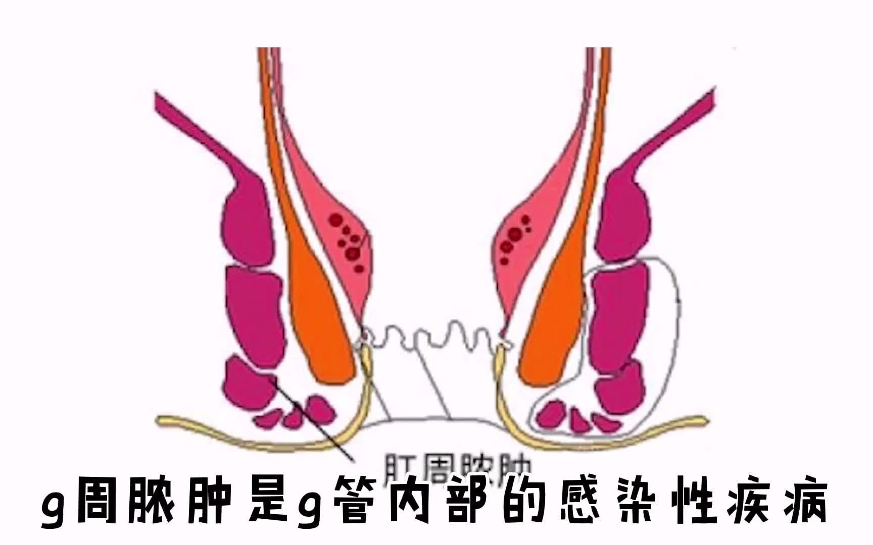 肛周脓肿自己会消除吗图片