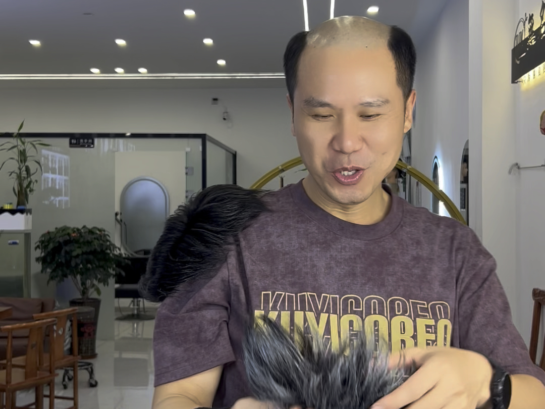 易县植发补发店(植发一次价格是多少钱)