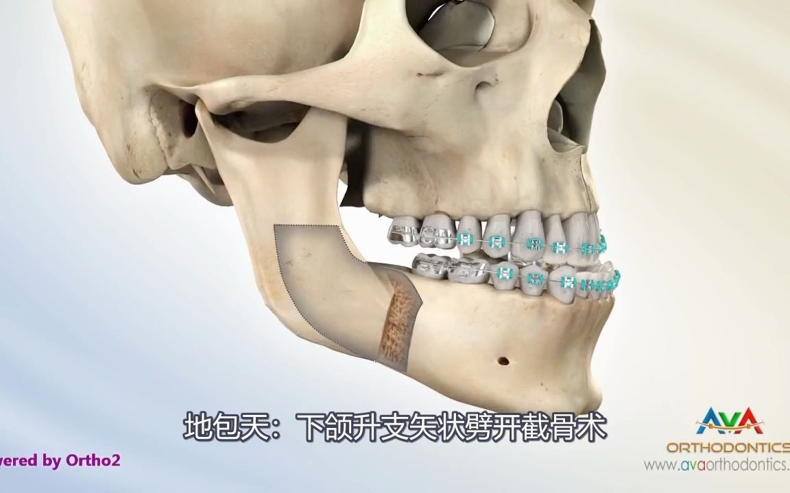 正颌动画地包天怎么办漏龈笑怎么办正颌手术有哪几种术式来了解一下吧