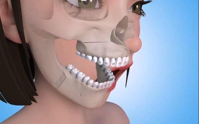 作业记录 | 医学动画正颌外科手术(龅牙)