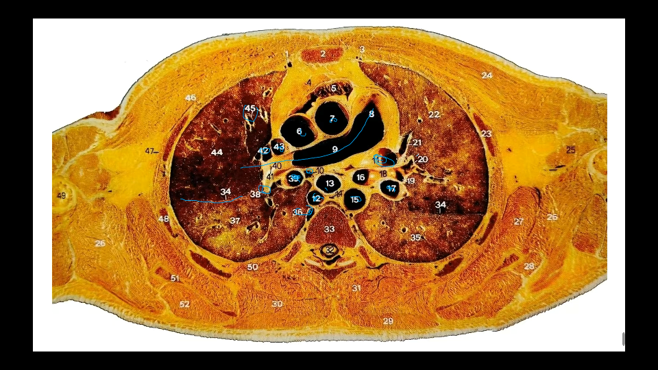 肺部ct解剖图 断层图片