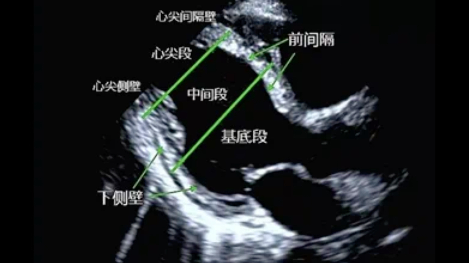 [图]超声心动图划分左室心肌各节段的学习分享