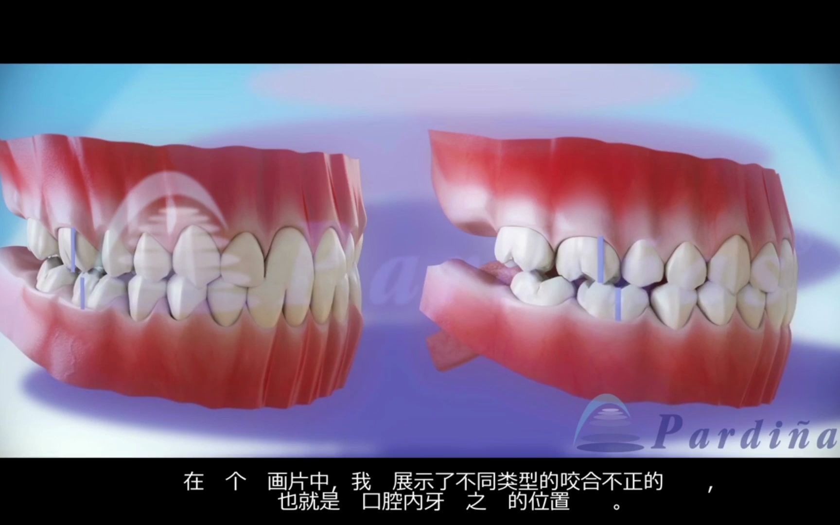 不同类型的牙齿咬合演示