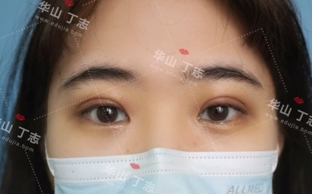 18岁姑娘做的68mm开扇型双眼皮7天啦