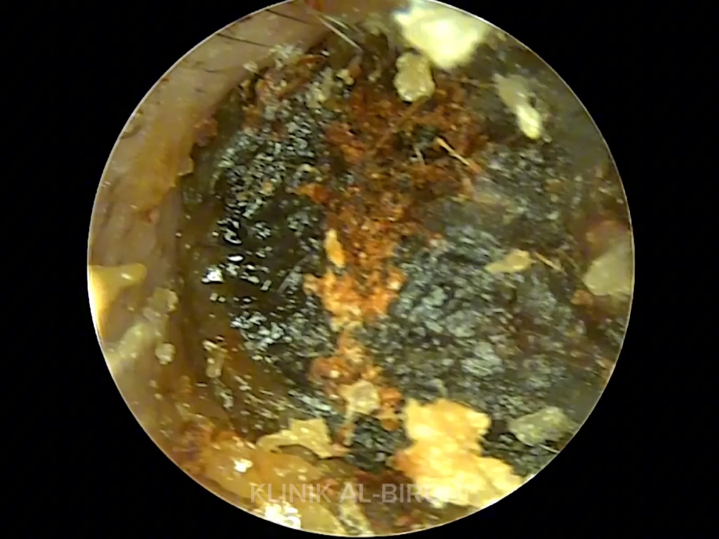 掏耳朵解压-巨大而坚硬,像岩石耳垢,完全堵塞耳道