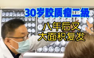 Descargar video: 30岁男子患胶质瘤二级，八年后又大面积复发，手术也很难下手