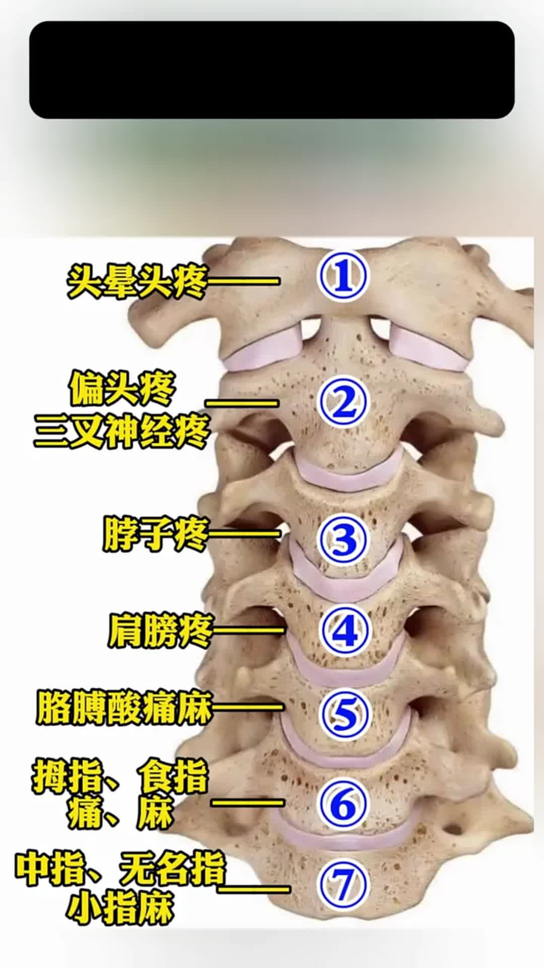 颈椎突出图片 位置图图片