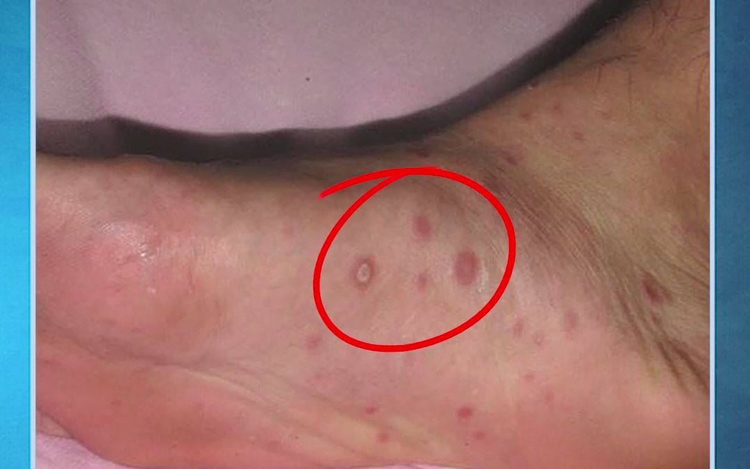 梅毒脚上的症状图片图片