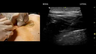 超声引导椎旁神经阻滞 Paravertebral Block Ultrasound-Guided Demonstration