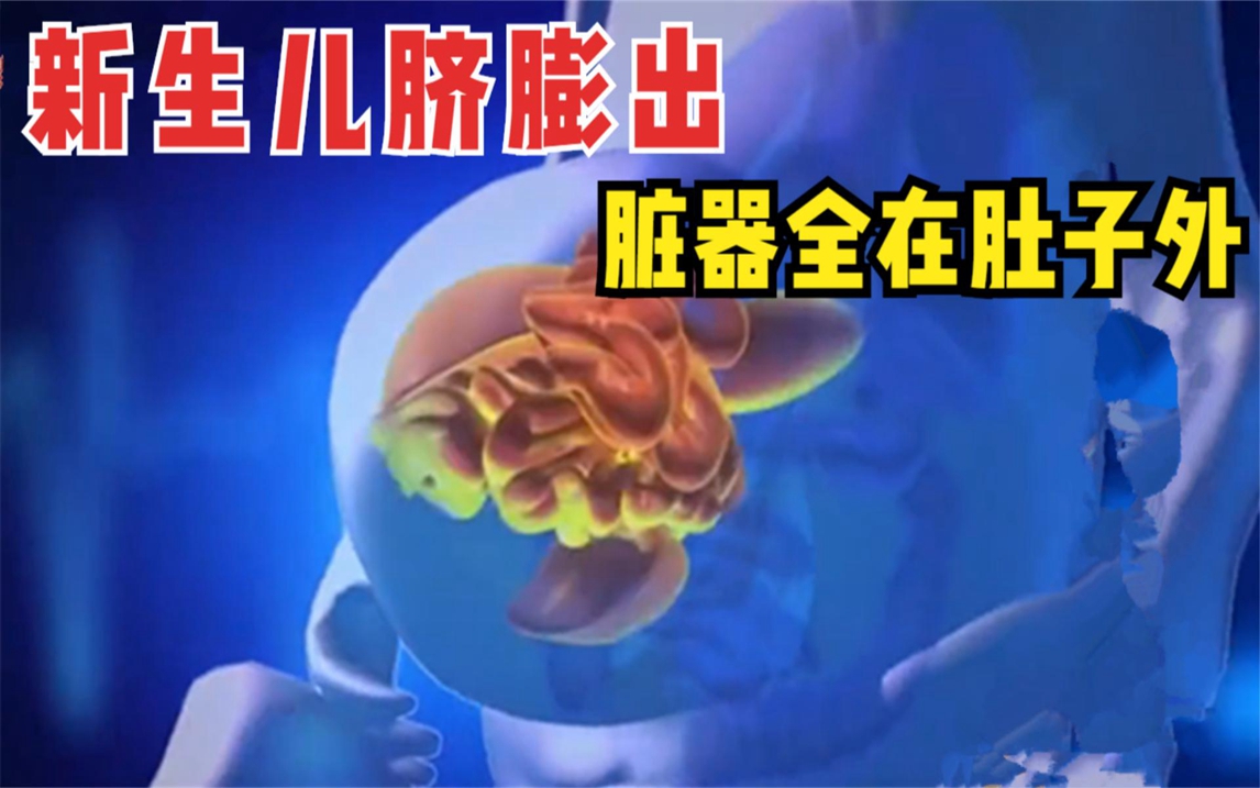 新生儿肚子上长大圆球,医生一席话吓坏家属,出生立即执行手术!