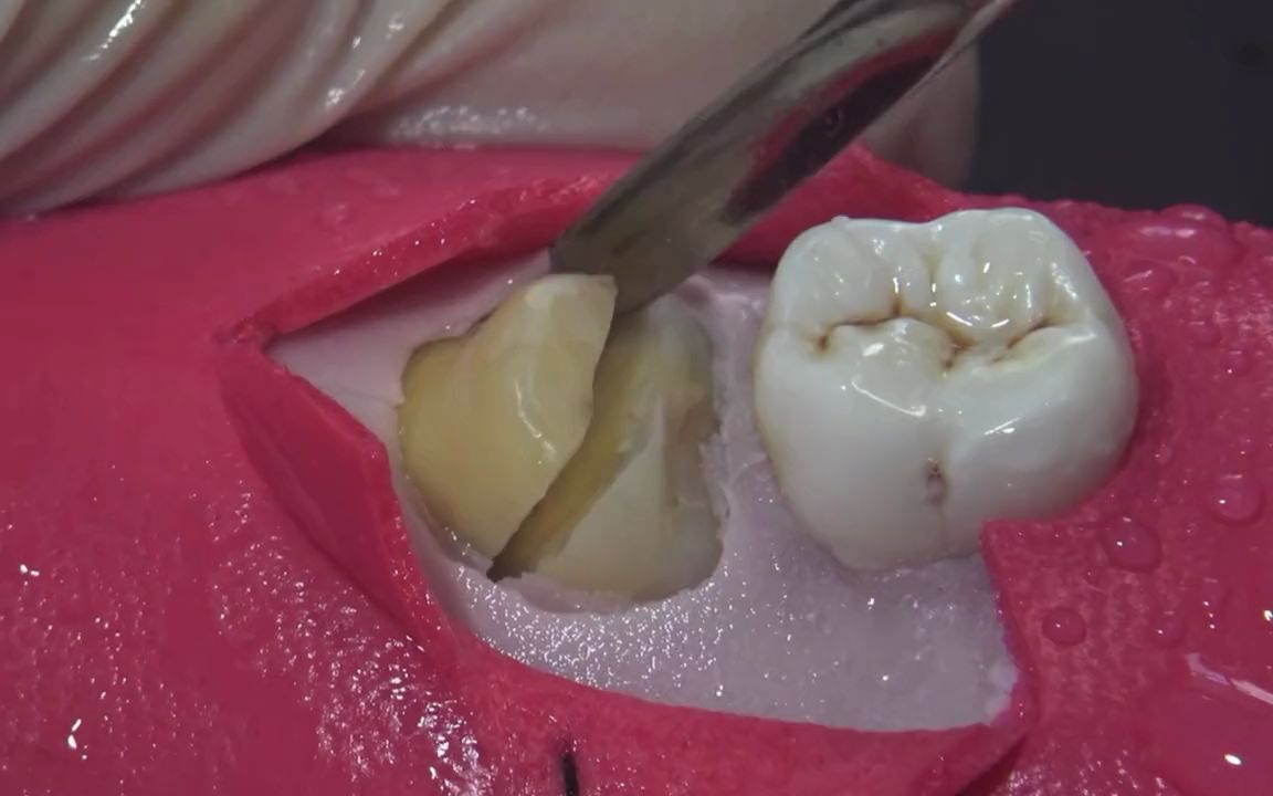 拔掉一颗智齿的全过程_哔哩哔哩_bilibili