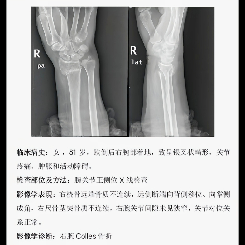腕关节正侧位:colles骨折