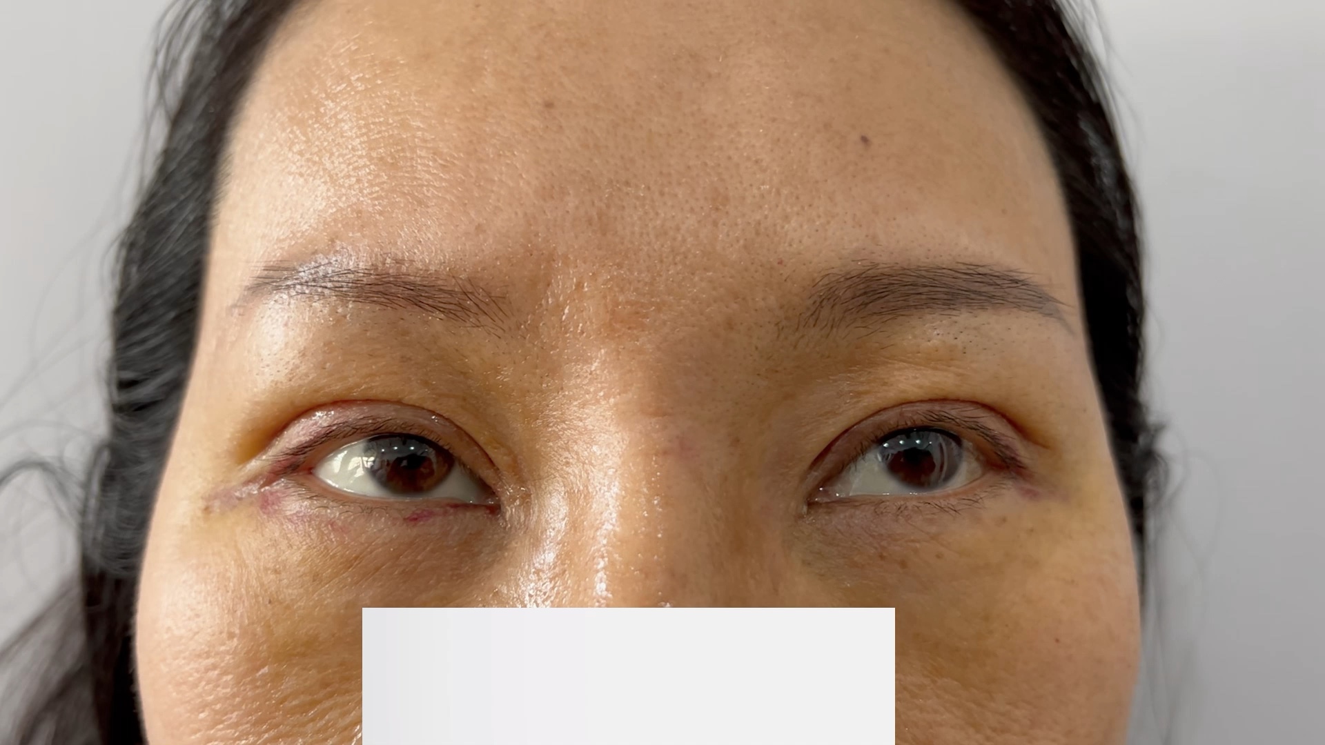 双眼皮修复宽改窄术后第六天反馈,术前情况往上翻!