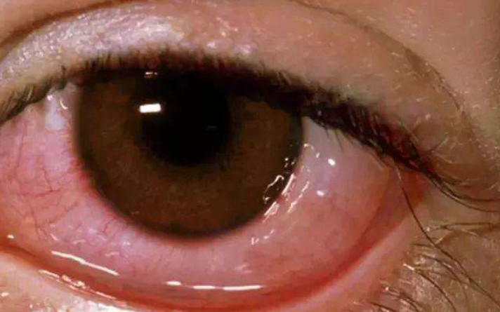 眼睛长透明小滤泡抗菌药品哪家强