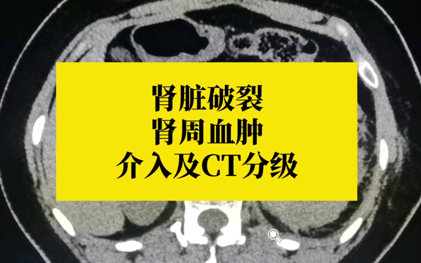 【急诊影像科普】外伤肾脏破裂,ct观察重点及分级._哔哩哔哩_bilibili