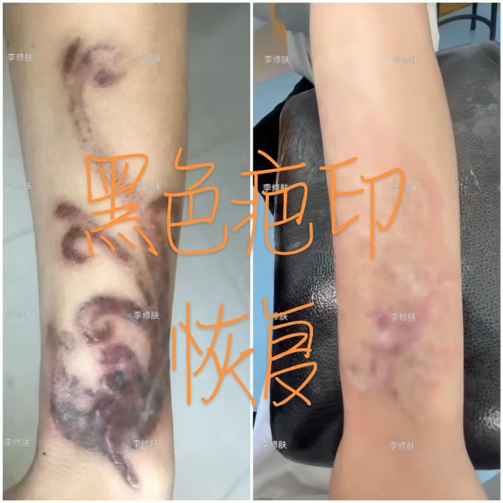 洗纹身失败留疤的修复过程