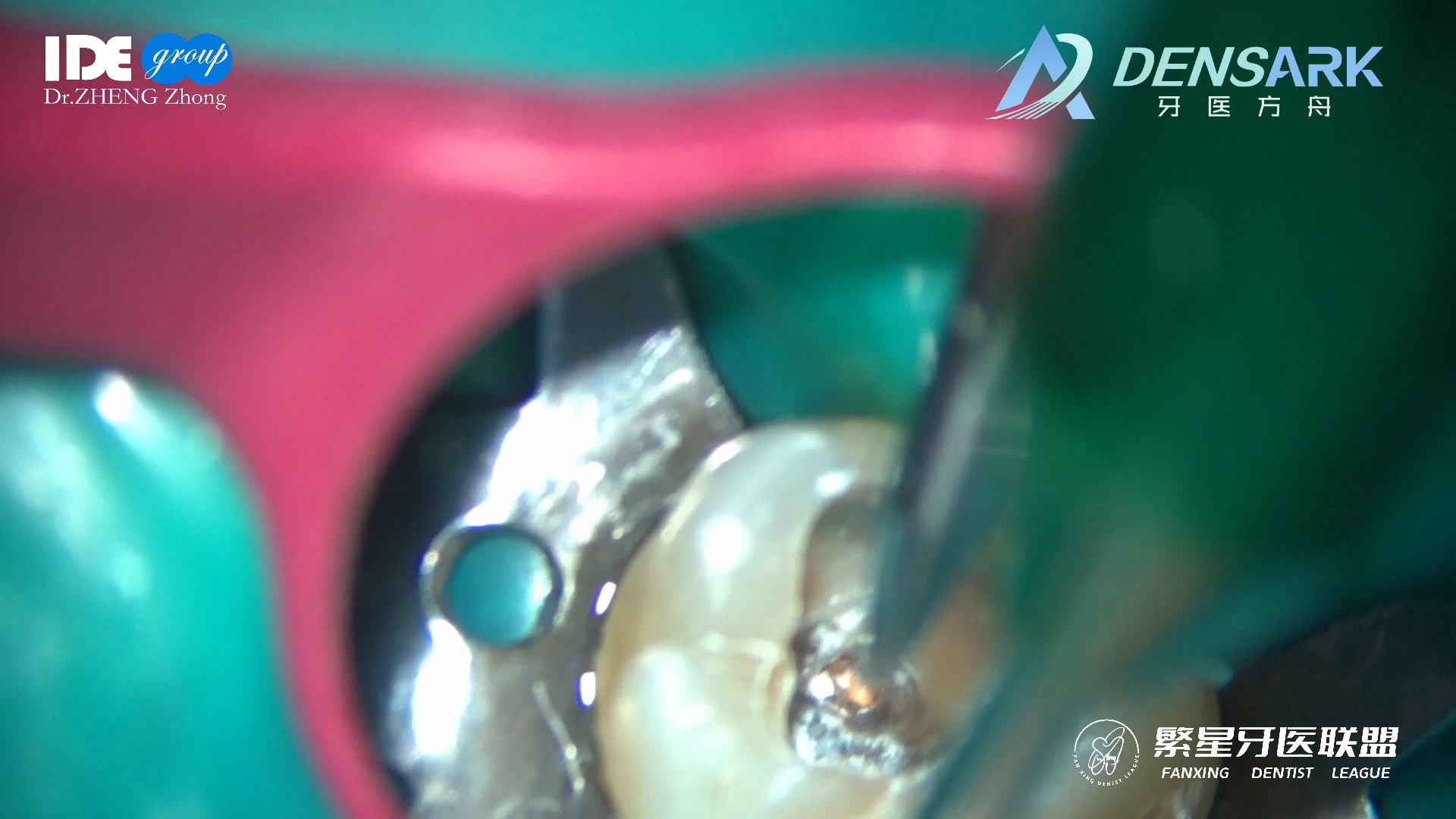 郑快乐工作日常之经历颇多的上颌第一磨牙根充