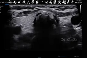 Download Video: 甲状腺ZT结节与甲状旁腺鉴别