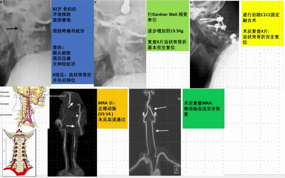 82岁老奶奶平地跌倒后 颈后疼痛 CT检查见颈椎齿状突骨折 向后严重移位,殃及椎动脉,怎样处理才能避免脑梗?哔哩哔哩bilibili