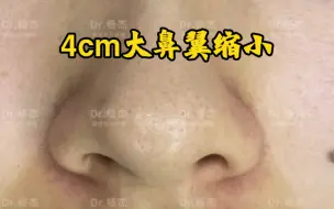 Download Video: 小姑娘4厘米大鼻翼缩小，外加术后6个月照片反馈，来看看吧