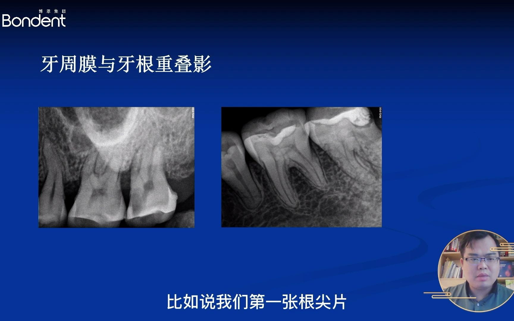 3牙根折裂根尖片中的鉴别诊断哔哩哔哩bilibili