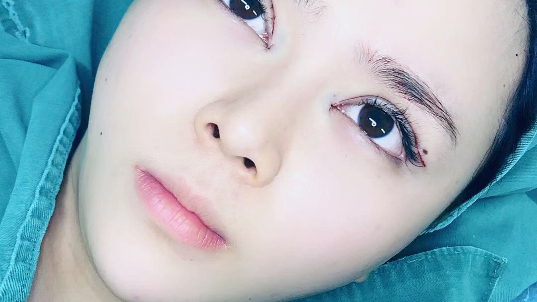 双眼皮宽改窄加提肌矫正加眼窝填充眼修复术后即刻[加油][加油][加油]
