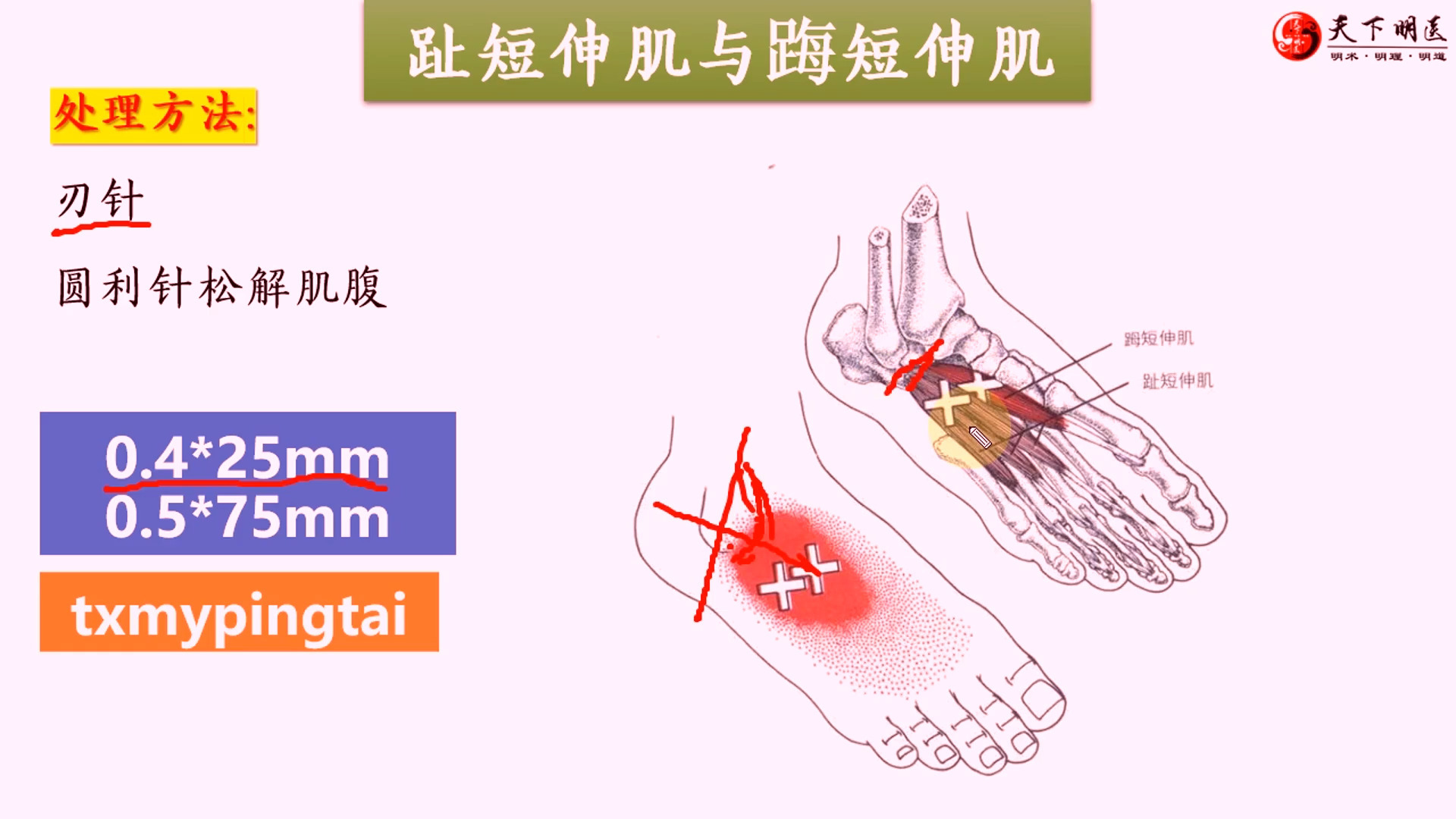 趾短伸肌和踇短伸肌——足部背面疼痛!