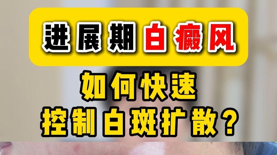 白癜风复发控制