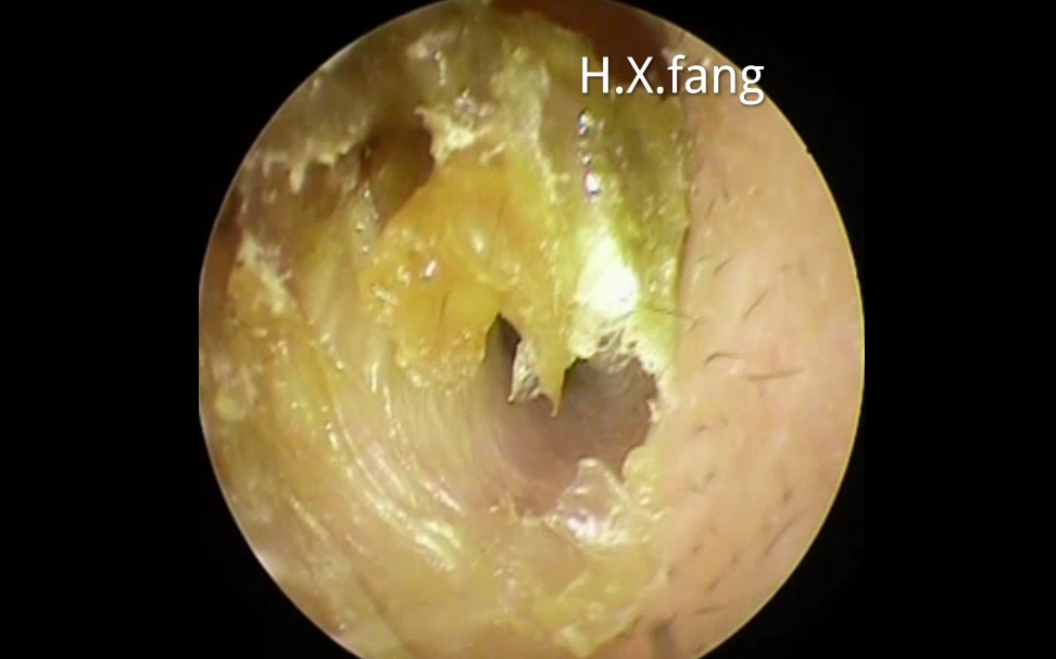 专业可视采耳-耳垢和死皮清除ear wax removal-dead skin cleaning