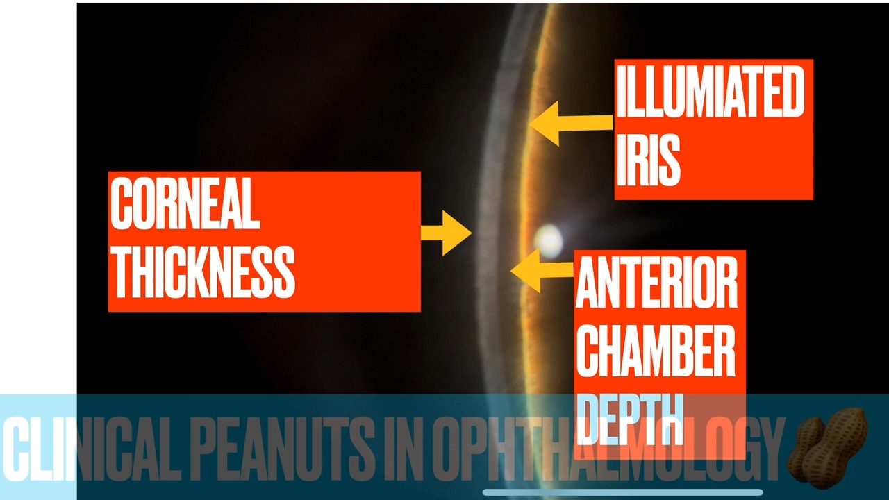 van herick & peripheral anterior chamber depth - 周边前房深度