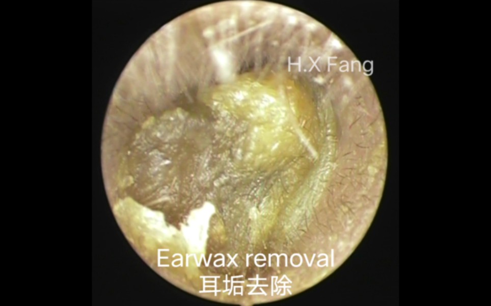 专业可视采耳Earwax removal耳垢去除(好多耳屎)20230924.03哔哩哔哩bilibili