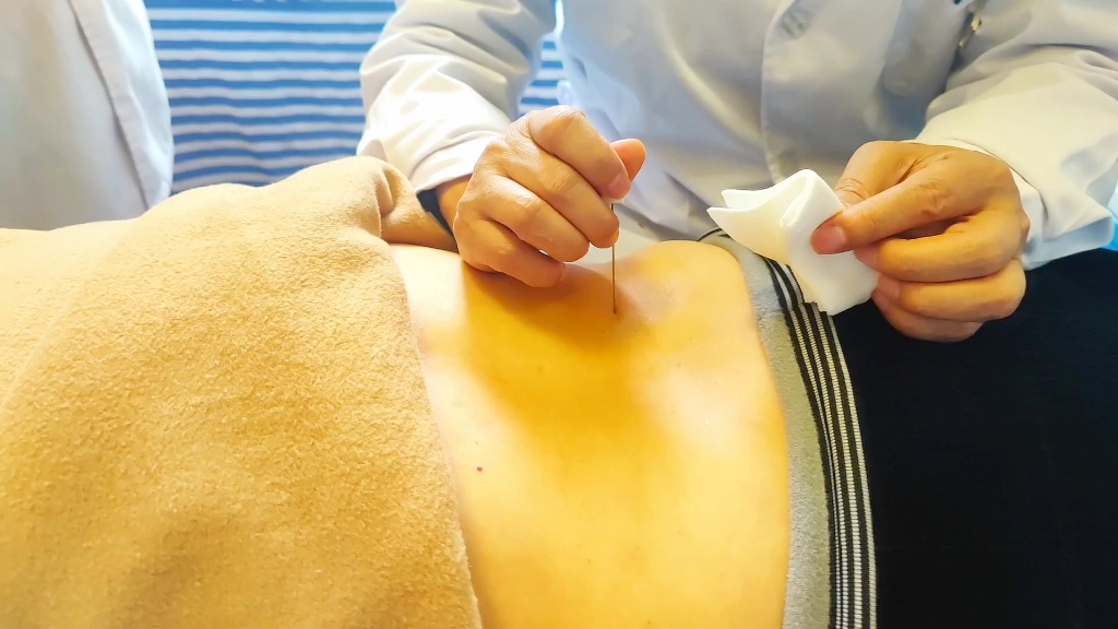 腰部疼痛原因解析,臀上皮神经卡压,针刀实操松解缓解症状