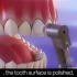 牙齿高清矫正
