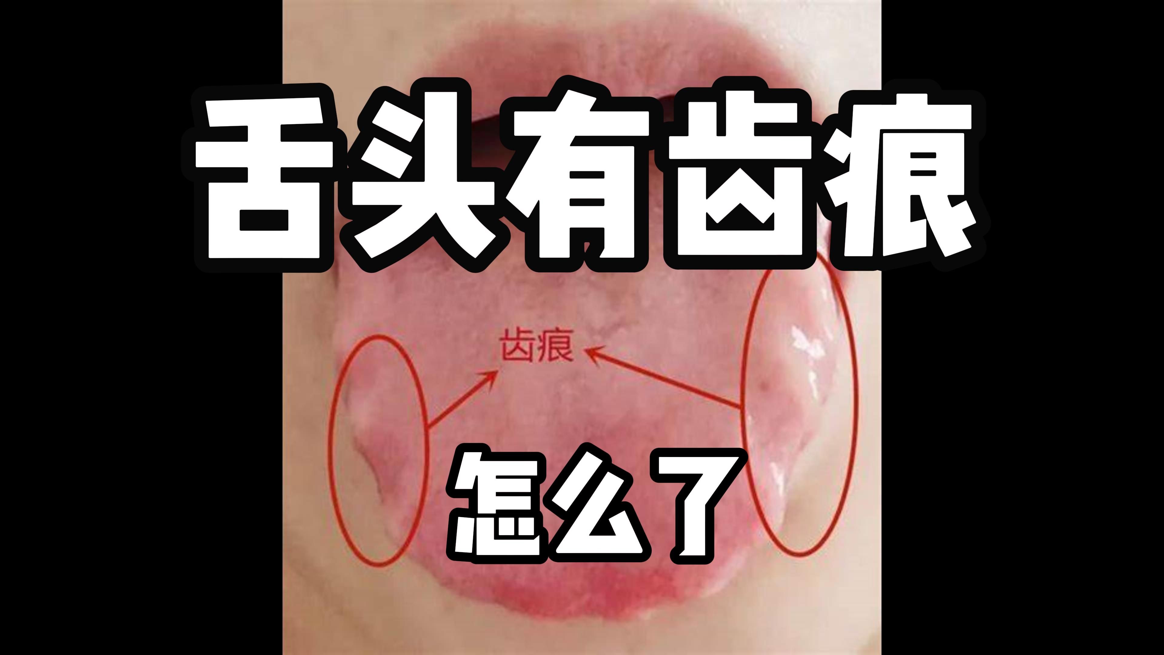 教大学牲生活之,舌头有齿痕了怎么办