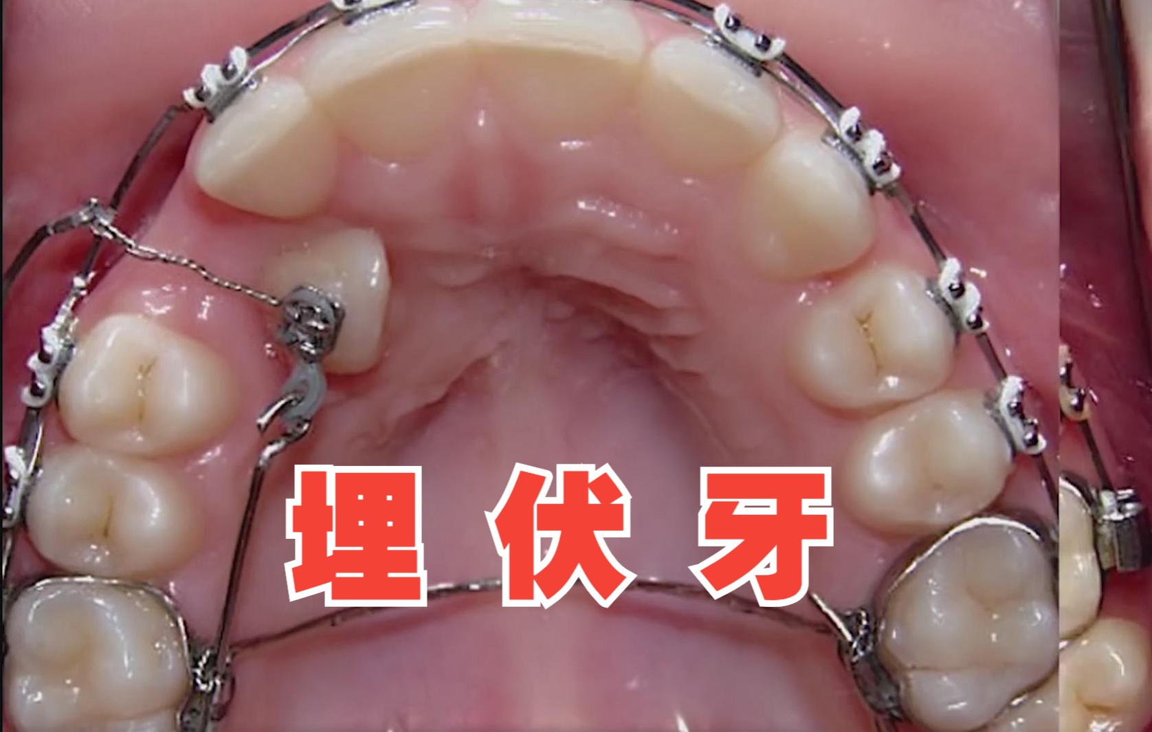 埋伏牙牵引术_哔哩哔哩_bilibili