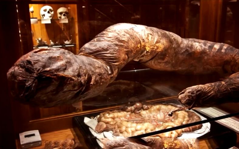 三年没上厕所,成为世界上第一被憋死的人,肠子跟电线杆一样粗!