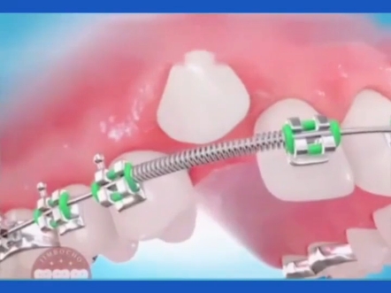 虎牙矫正动画演示过程分享!