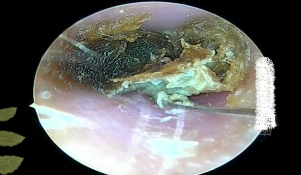 硬邦邦的好大一坨、把整个耳道堵的严严实实 严重影响听力了哔哩哔哩bilibili