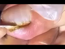 【甲沟炎】嘶，看着都疼