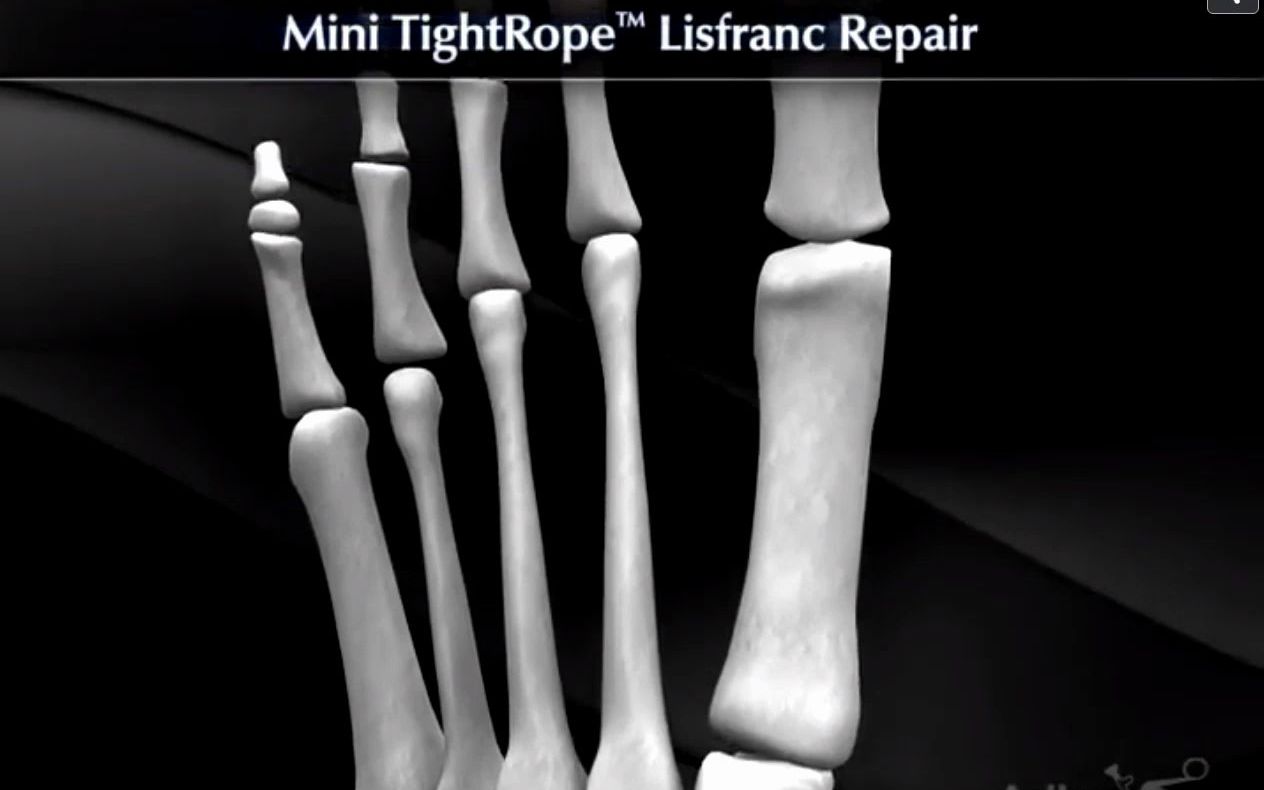 [图]Mini TightRope® Lisfranc Repair