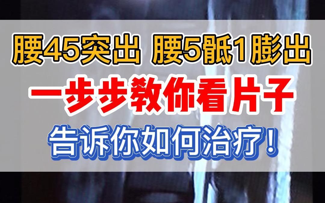 腰椎间盘突出,教你看核磁片子!哔哩哔哩bilibili