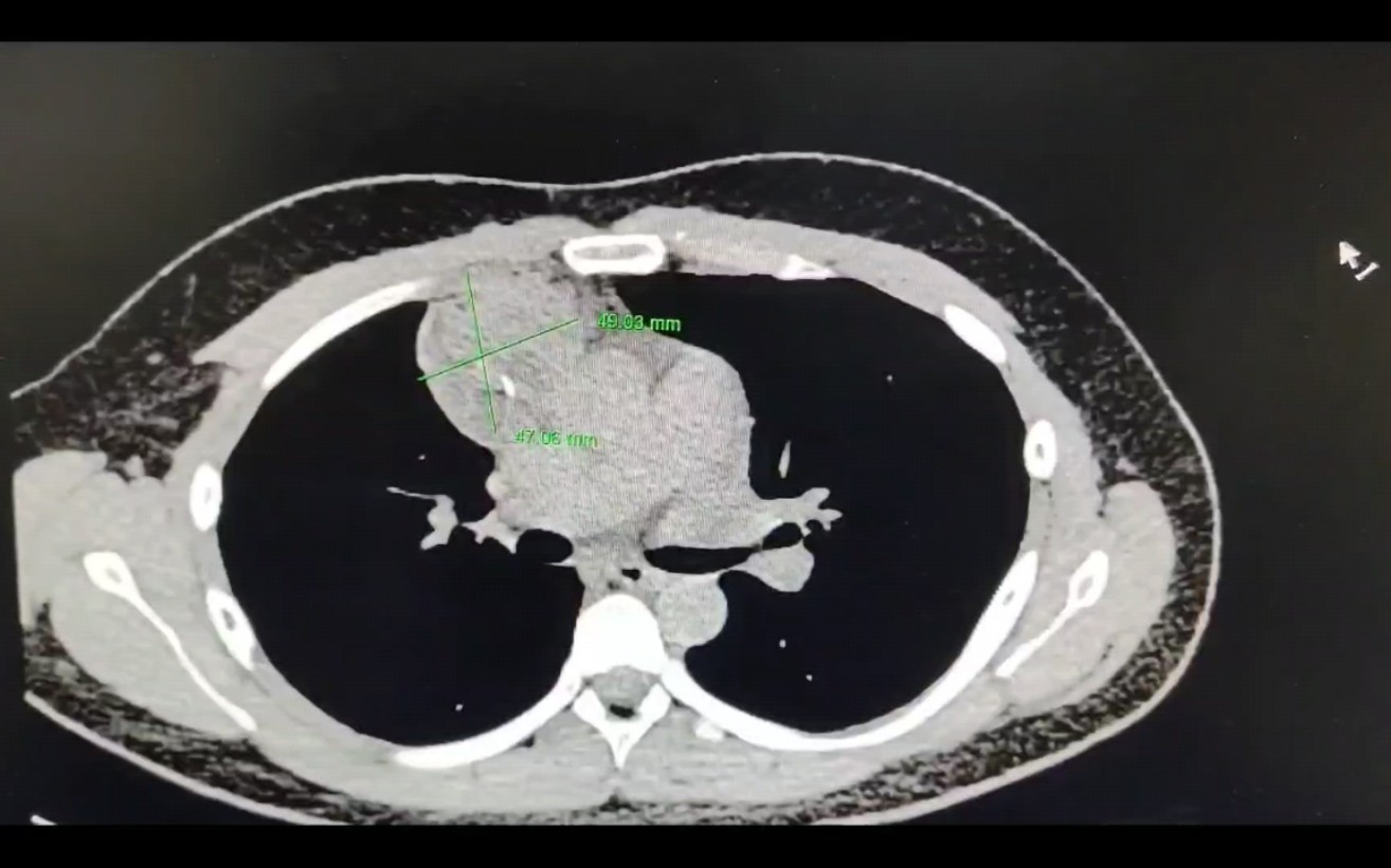 影像看:前纵隔肿瘤哔哩哔哩bilibili