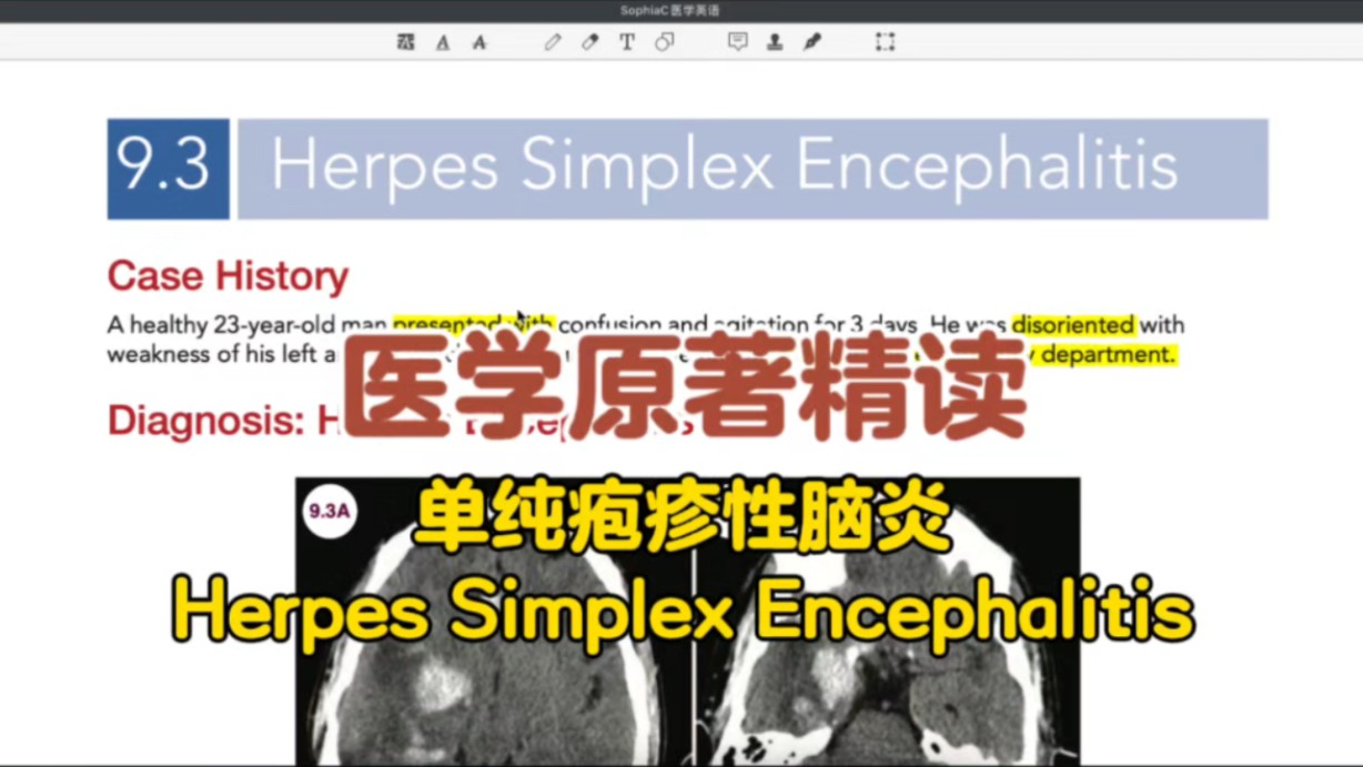 SophiaC医学英语|医学原著精读|单纯疱疹性脑炎Herpes Simplex Encephalitis哔哩哔哩bilibili