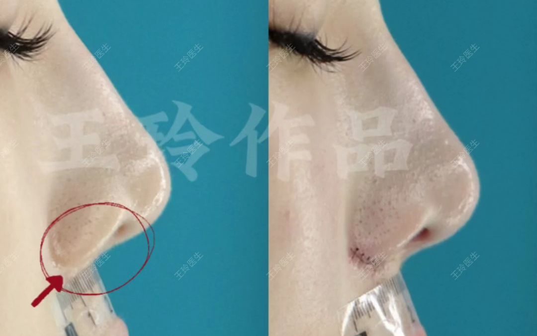 鼻翼缩小之鼻翼缘上提