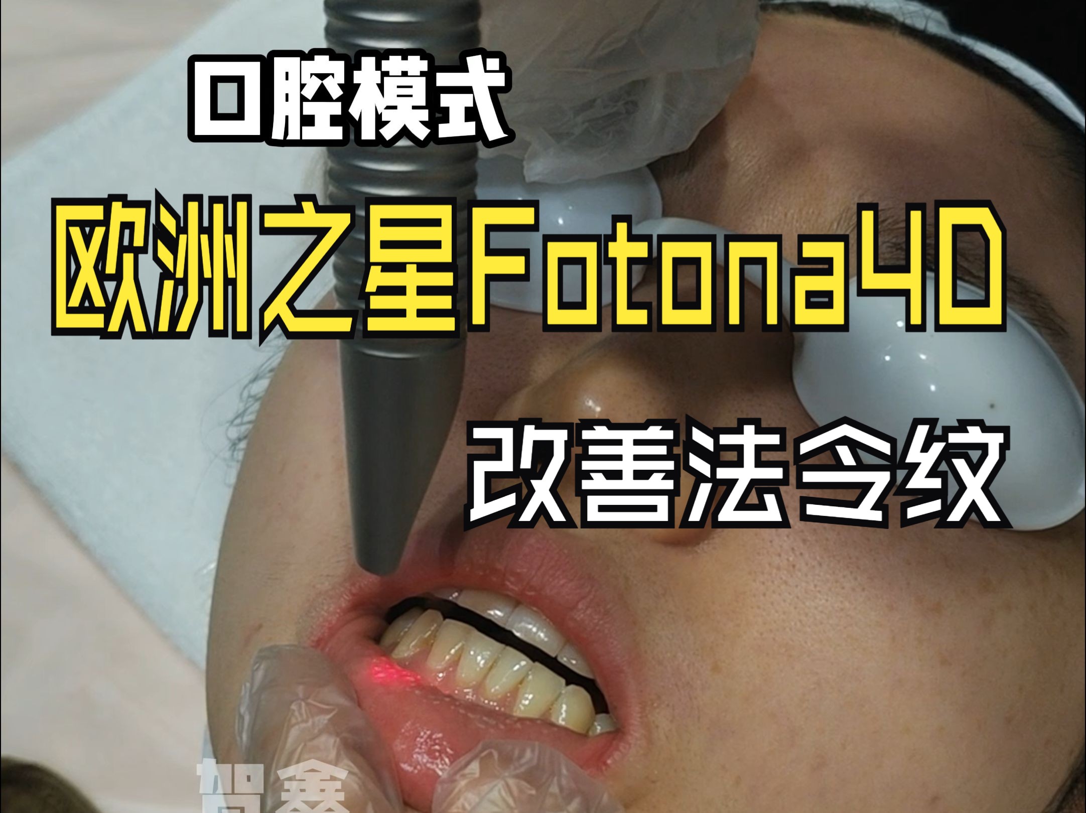 医美界网红抗衰仪器欧洲之星Fotona4D操作演示哔哩哔哩bilibili